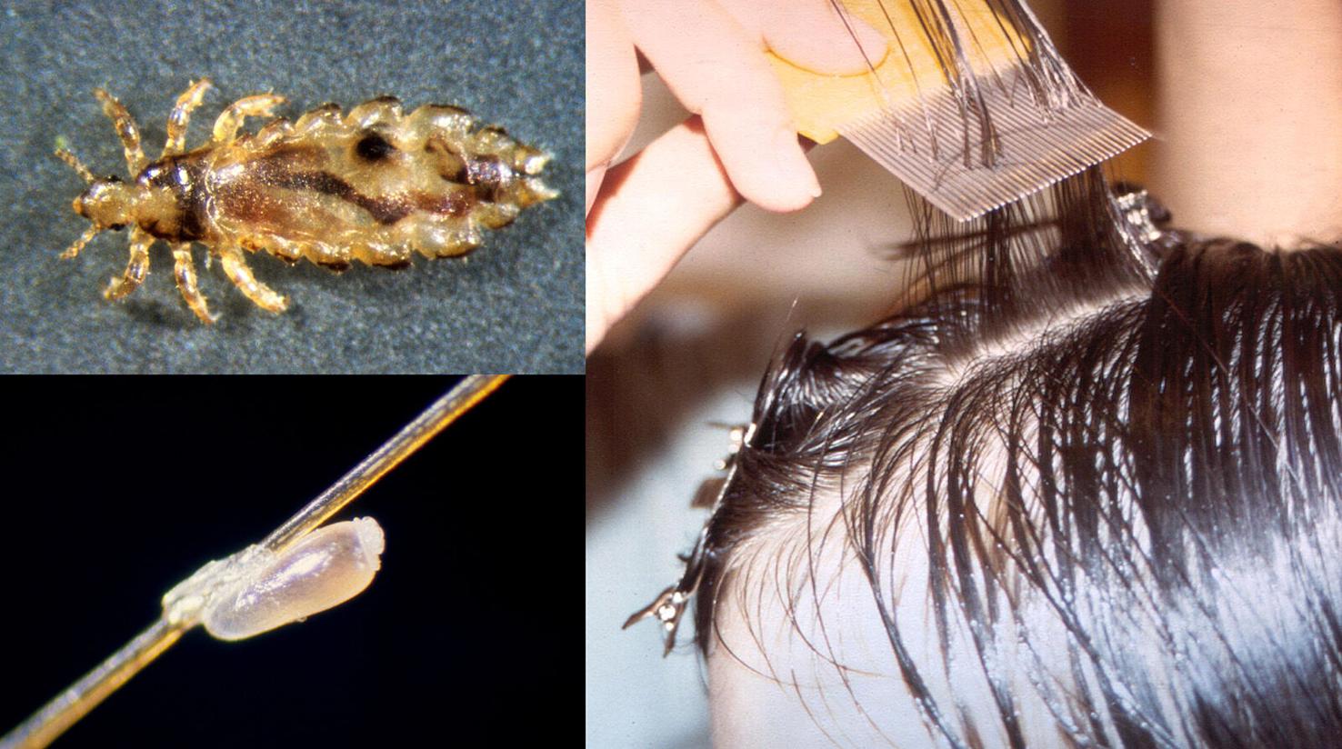 How To Get Rid Of Head-Lice Infestation In Your Child